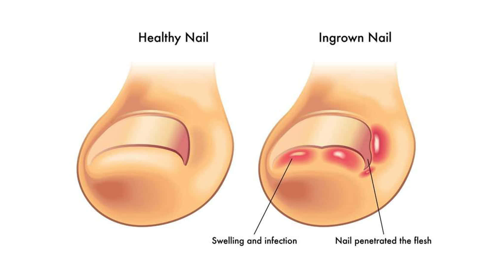 Ingrown toenails